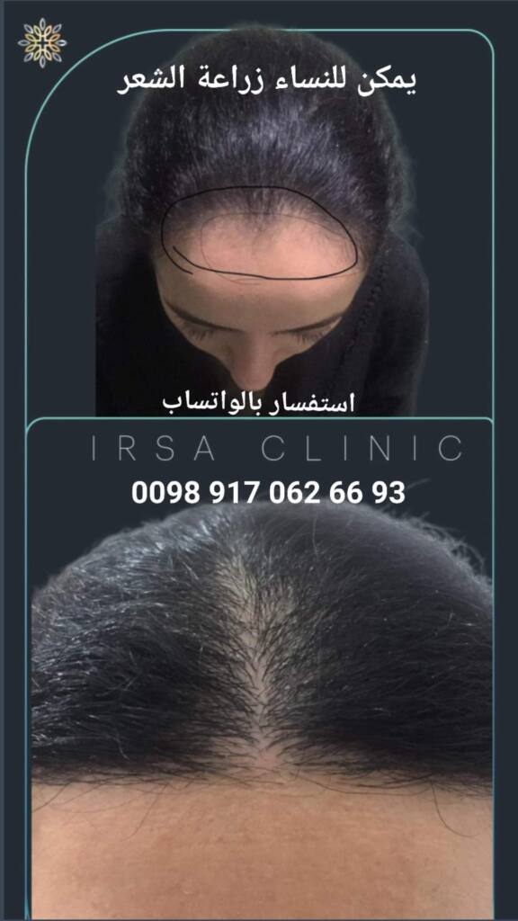 زراعة الشعر للنساء بدون حلاقة الرأس بالكامل في شيراز ايران