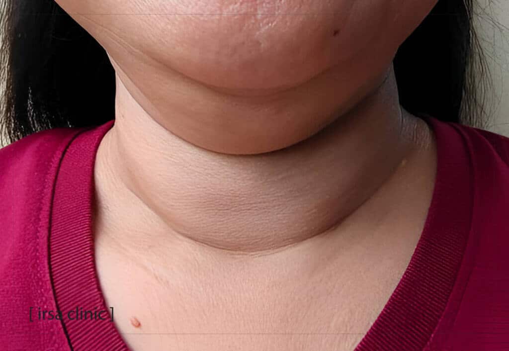 Non-invasive medical methods for removing a double chin