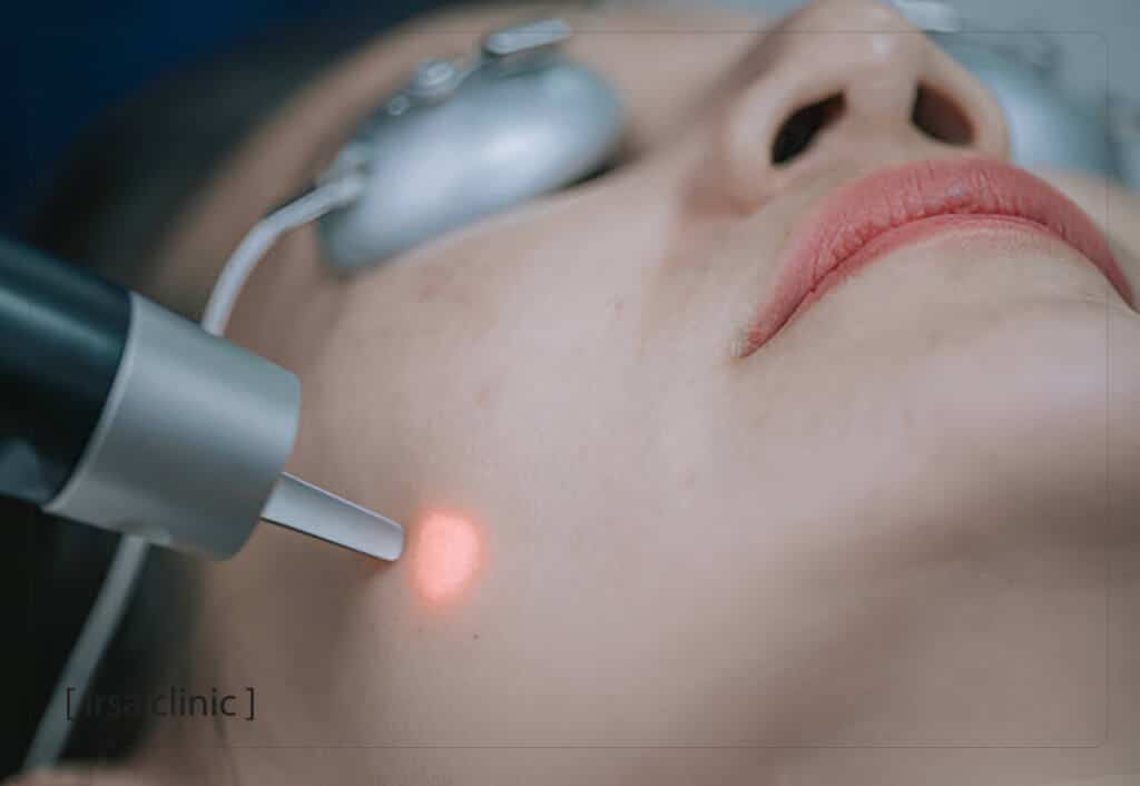 مراقبت‌های مهم قبل از لیزر فوتونا به منظور رفع لک و کک و مک