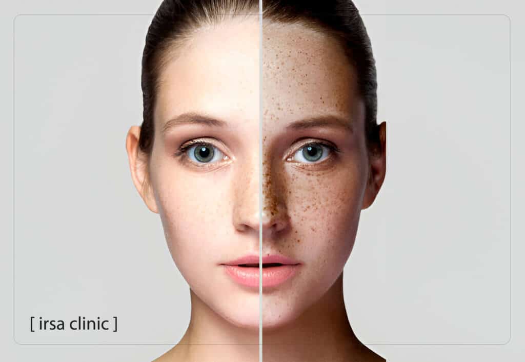 Are there any side effects of Fotona laser?