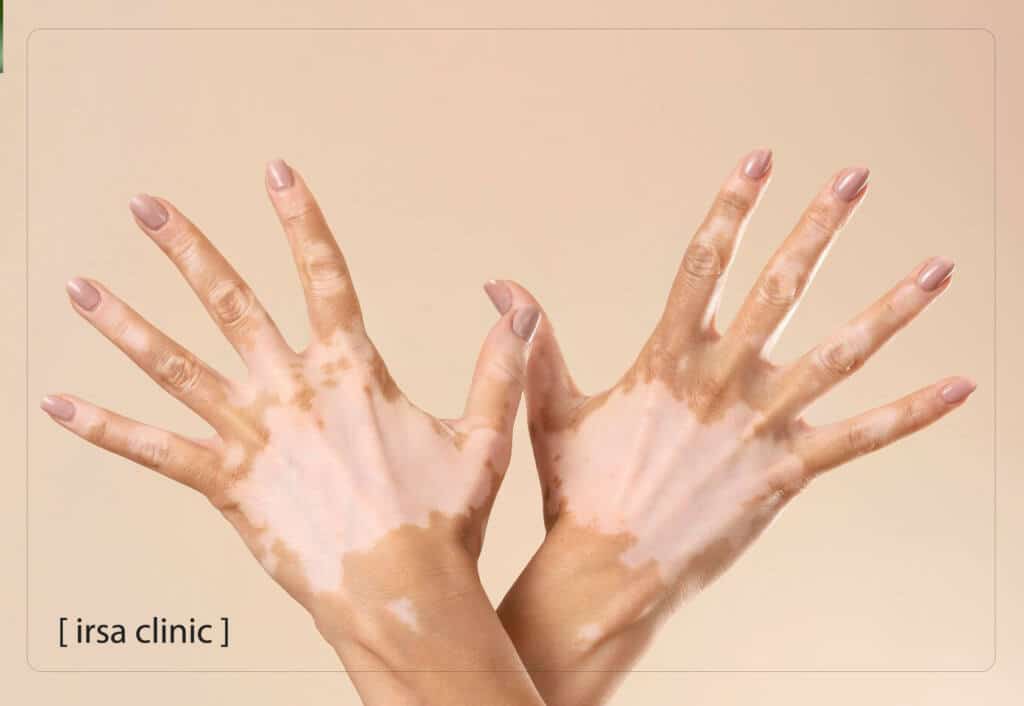 Stages of vitiligo treatment in Shiraz with light therapy or phototherapy
