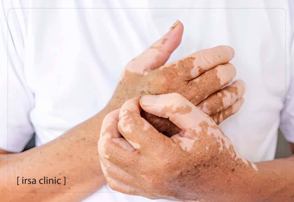  Light therapy aftercare in Shiraz for the vitiligo treatment
