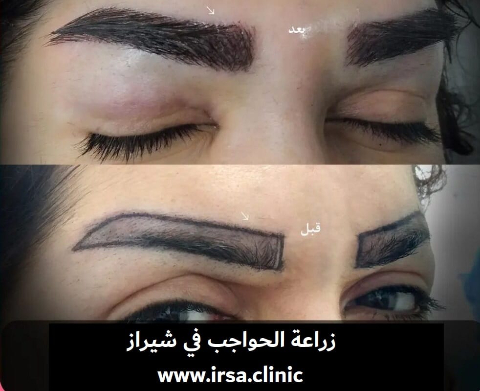 افضل المرشحون لعملية زراعة الحواجب في شيراز ايران 