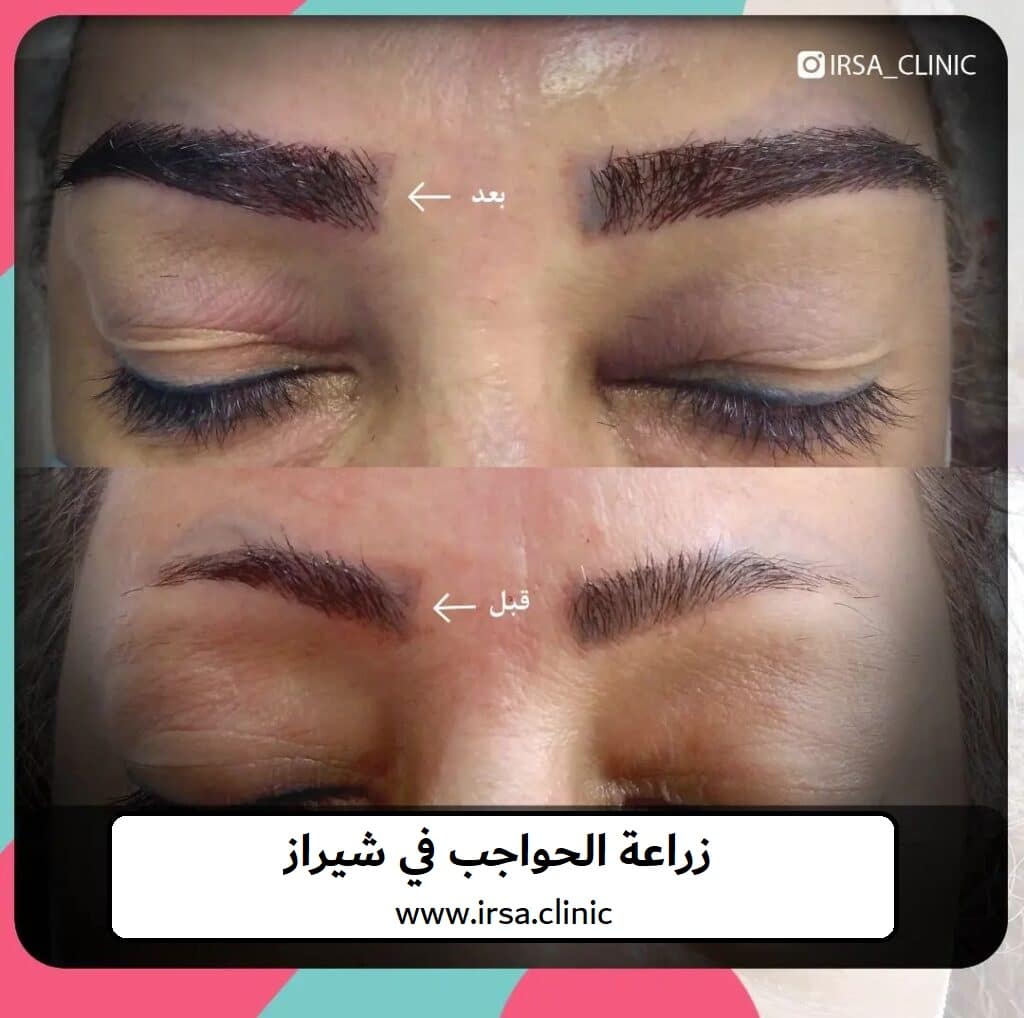زراعة الحواجب بتقنية FUT NEEDLING