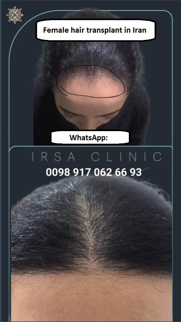 Why choose the FIT technique at Irsa Clinic in Shiraz?