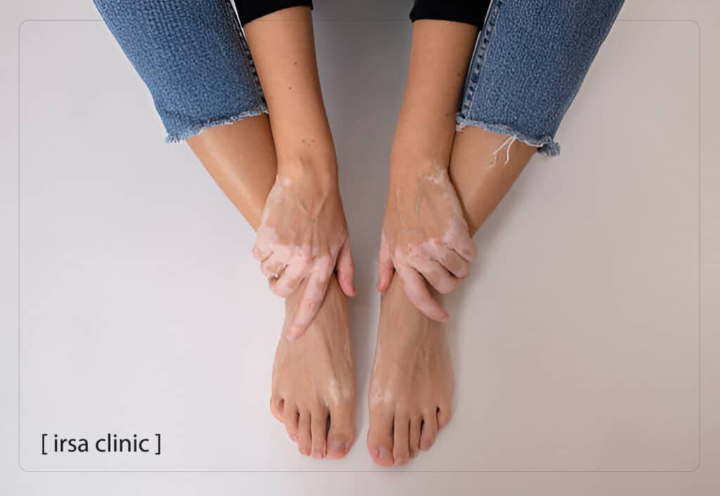 Vitiligo treatment in Shiraz