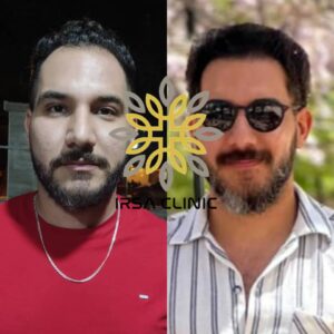Men's Hair Transplant in Iran