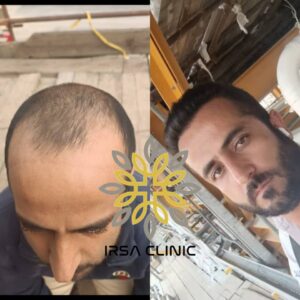 Men's Hair Transplant in Iran