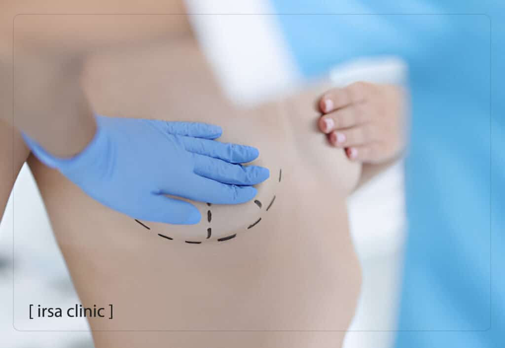 Possible complications of breast lift