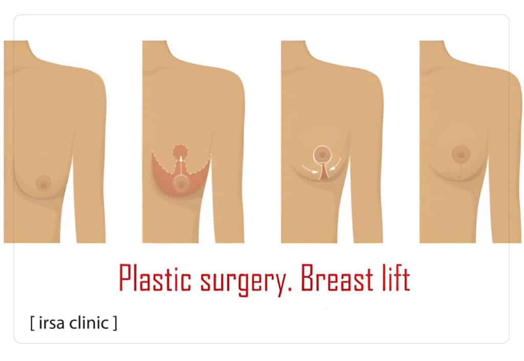 Steps of breast lift (Mastopexy) procedures in Shiraz