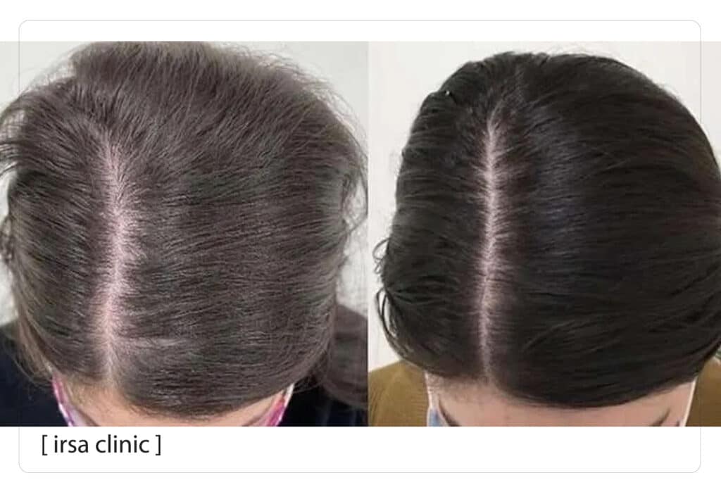 ما هي فوائد العلاج بالإكسوزوم في شيراز لعلاج تساقط الشعر؟