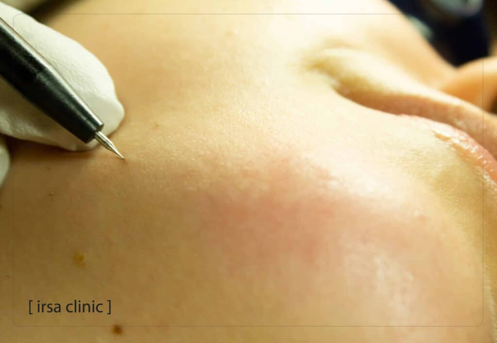 Which method is more suitable for me? Electrolysis or laser?