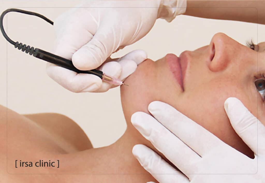 Advantages of electrolysis devices in Shiraz compared to laser
