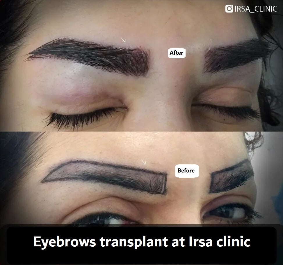 Eyebrow hair loss treatment