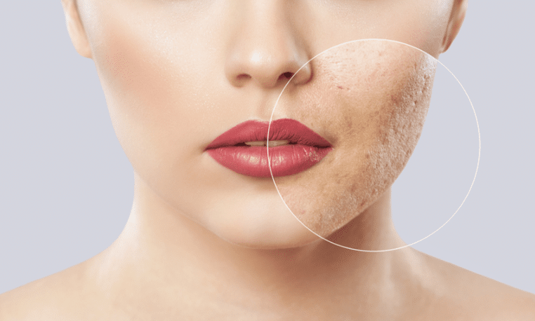Who are the suitable candidates for Subcision?