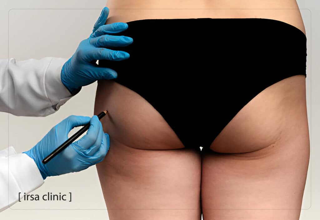 تزریق چربی به باسن در شیراز