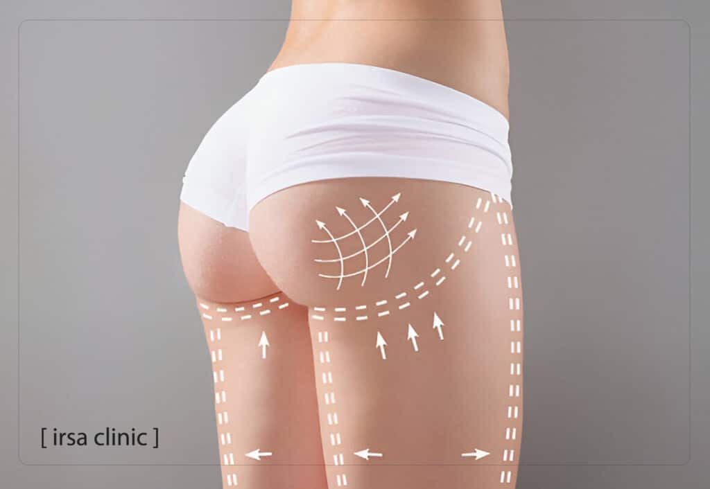 مراقبت های بعد از تزریق چربی به باسن در شیراز