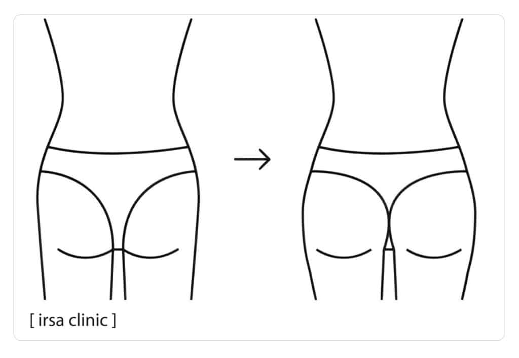 بهترین کلینیک برای تزریق چربی باسن در شیراز