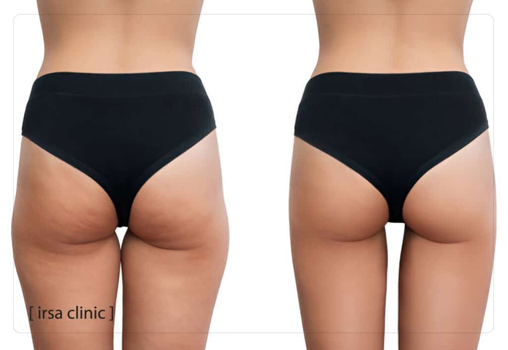 معایب تزریق چربی به باسن در شیراز