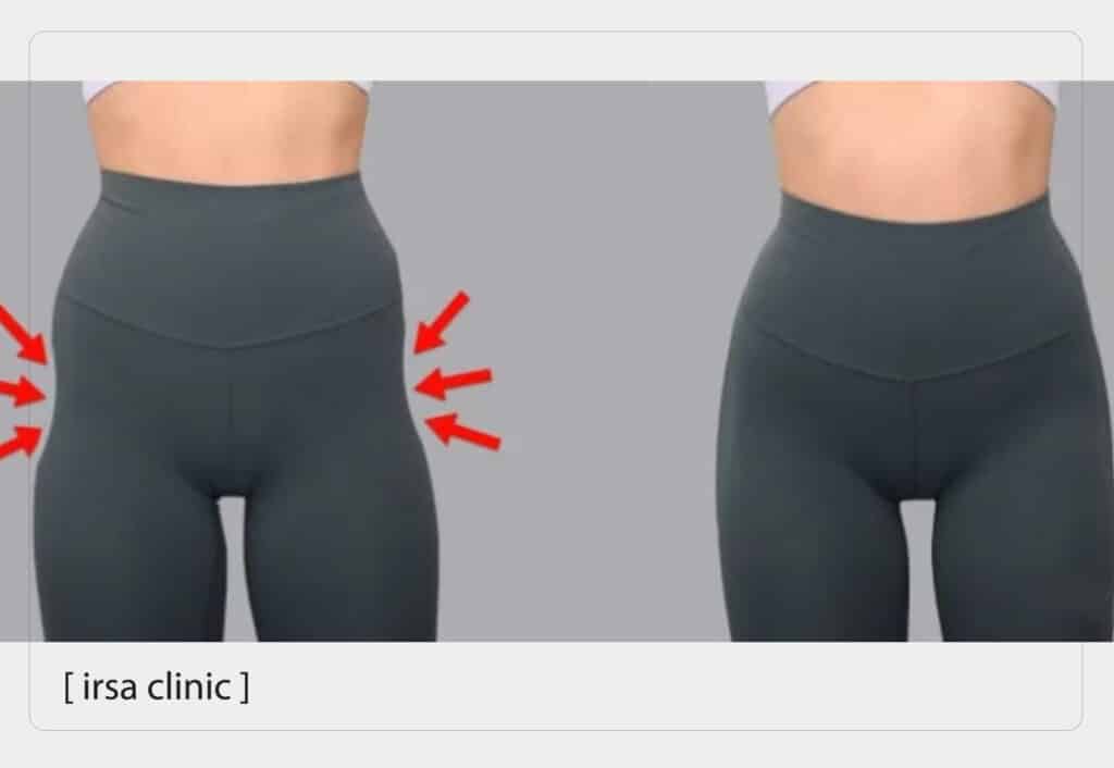 Can athletes inject body fillers?