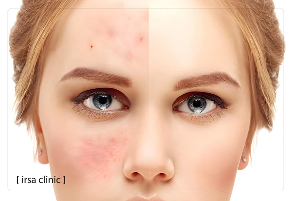 هزینه درمان جای جوش با لیزر فوتونا