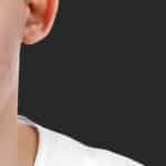 درمان جای جوش با لیزر فوتونا در شیراز