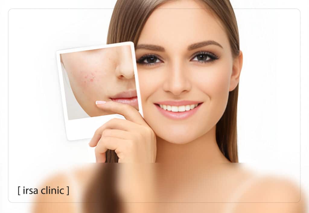 درمان جای جوش در شیراز با فوتونا