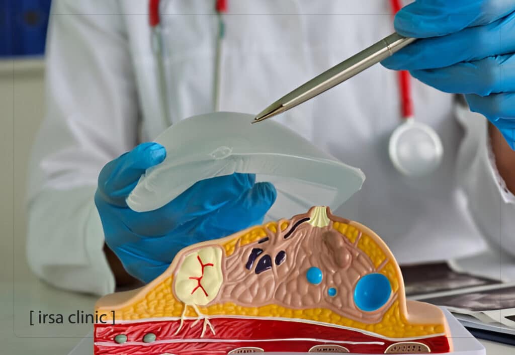 How is a ruptured implant diagnosed?