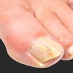 انواع قارچ ناخن و بهترین روش‌های درمان