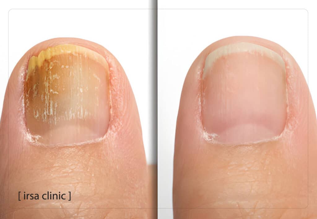 علتهای اصلی قارچ ناخن