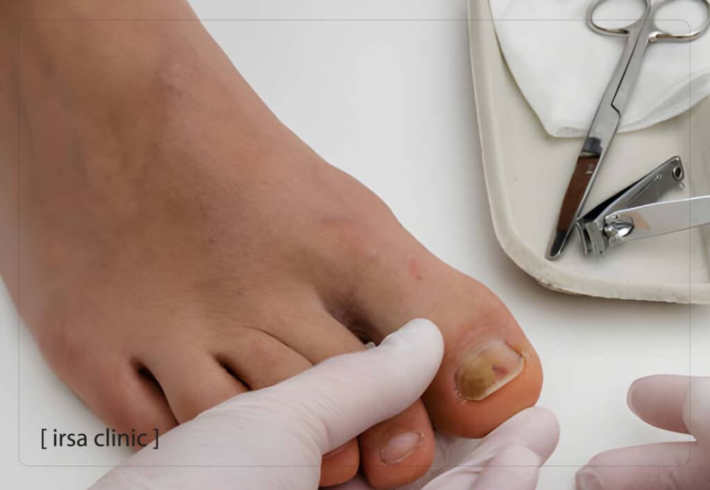 چند اشتباه رایج که باعث طولانی شدن درمان قارچ ناخن میشودچند اشتباه رایج که باعث طولانی شدن درمان قارچ ناخن میشود