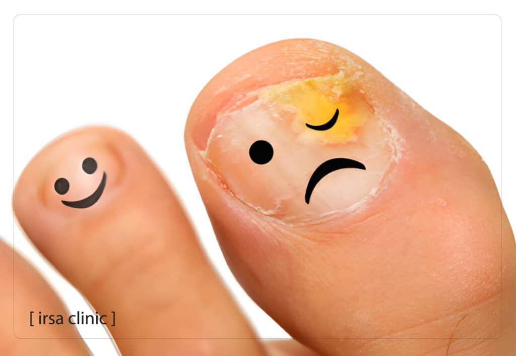 بهترین درمان قارچ ناخن در شیراز