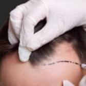آیا با وجود قند خون یا دیابت می‌توان کاشت مو انجام داد؟