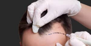 آیا با وجود قند خون یا دیابت میتوان کاشت مو انجام داد؟