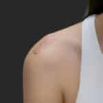 انواع اسکار (جای زخم) و روشهای نوین درمان آنها