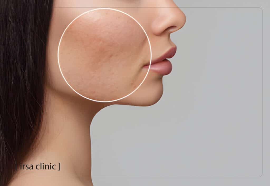 Stages of Fotona Laser Scar Treatment