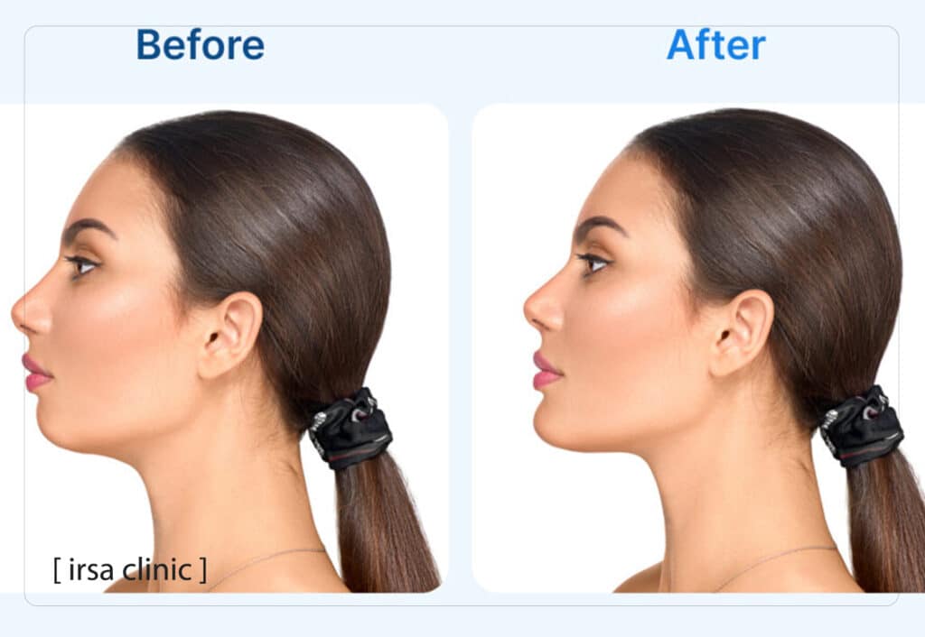 تزریق فیلر چانه در شیراز