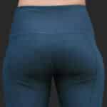 اشتباهات رایج در تزریق فیلر هیپ دیپ که نتیجه را خراب میکند؟