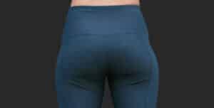 اشتباهات رایج در تزریق فیلر هیپ دیپ که نتیجه را خراب می‌کند