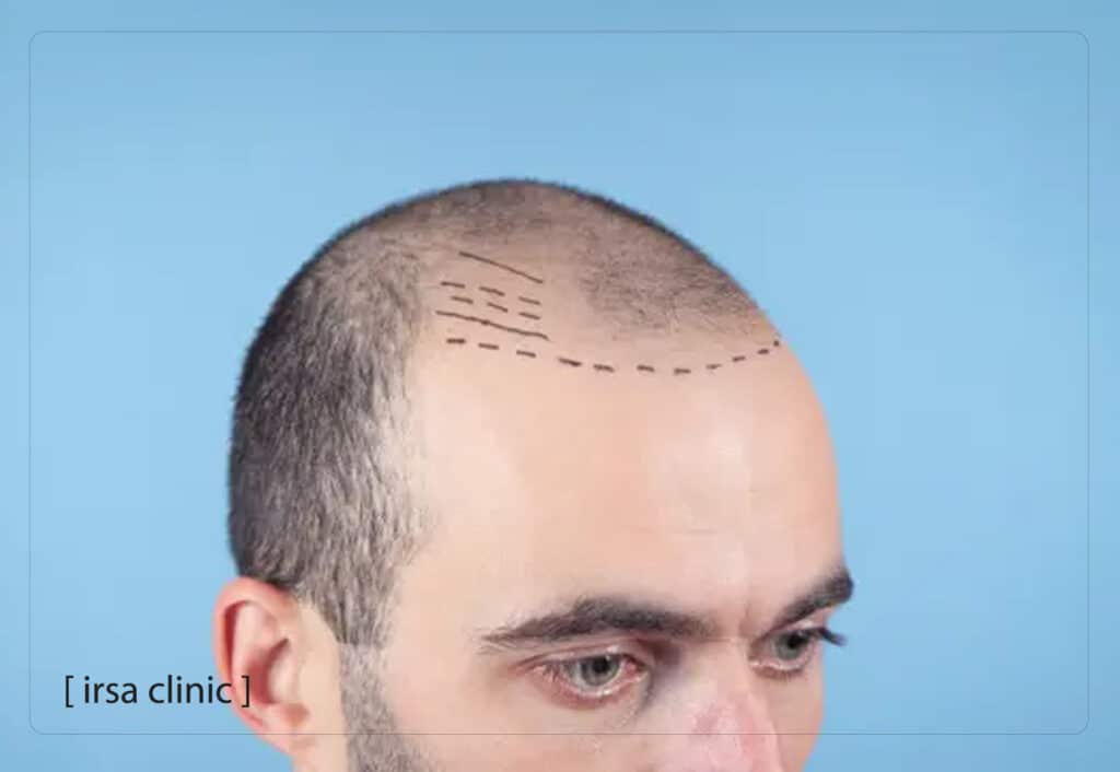 ترکیب PRP در شیراز و اگزوزومتراپی در شیراز برای کاشت مو در شیراز