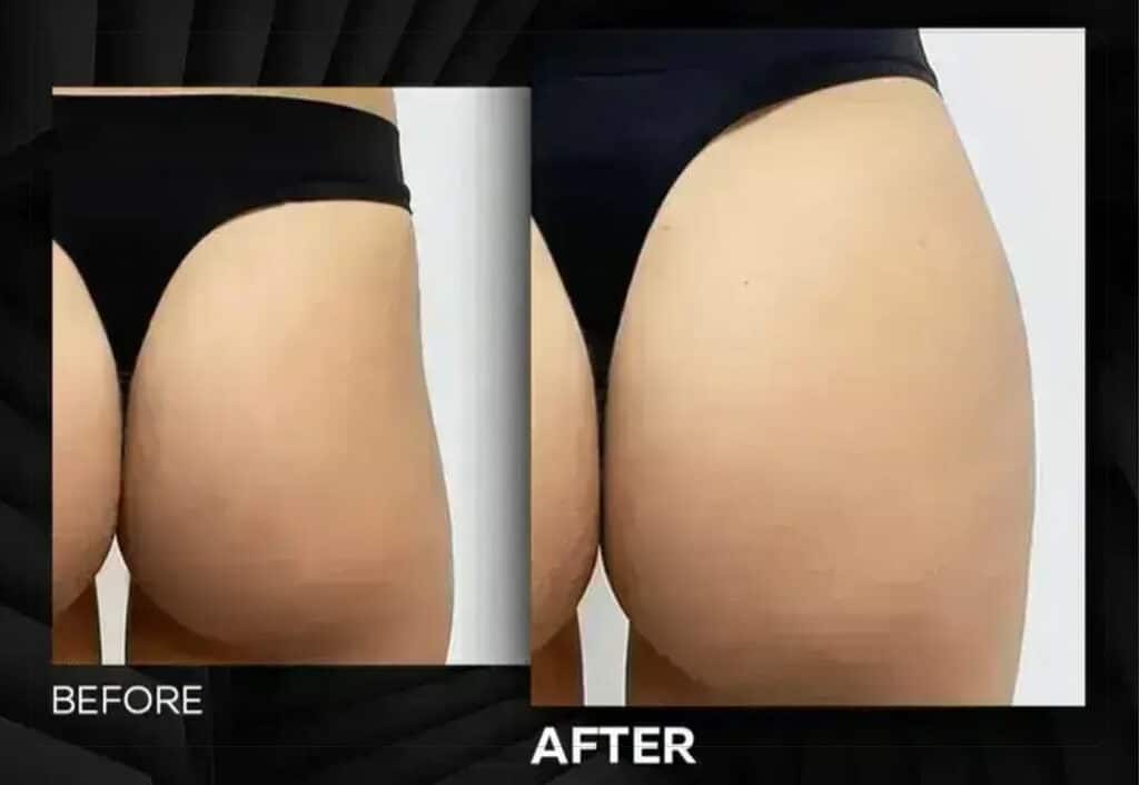 بهترین کلینیک تزریق فیلر بادی در شیراز