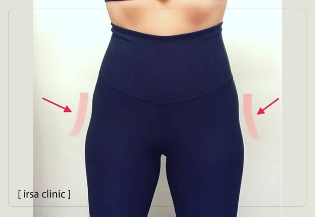 اشتباهات رایج در تزریق فیلر هیپ دیپ که نتیجه را خراب میکند؟