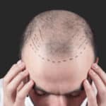 چگونه با استفاده از اگزوزومتراپی و PRP میزان موفقیت در کاشت مو را چندین برابر افزایش داد؟