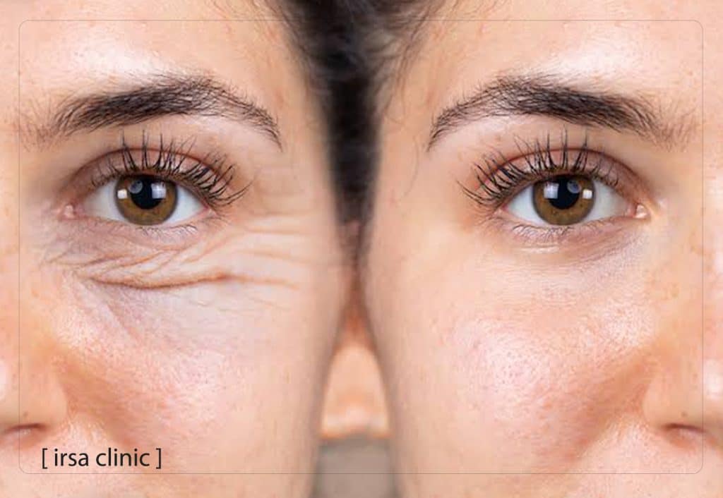 تفاوت جوانسازی با سلول بنیادی و PRP چیست؟