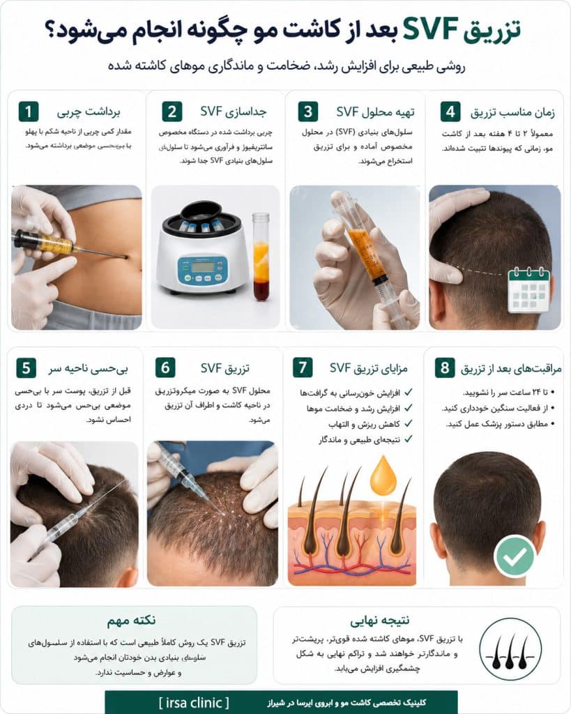 تزریق SVF بعد از کاشت مو در شیراز چگونه انجام میشود؟