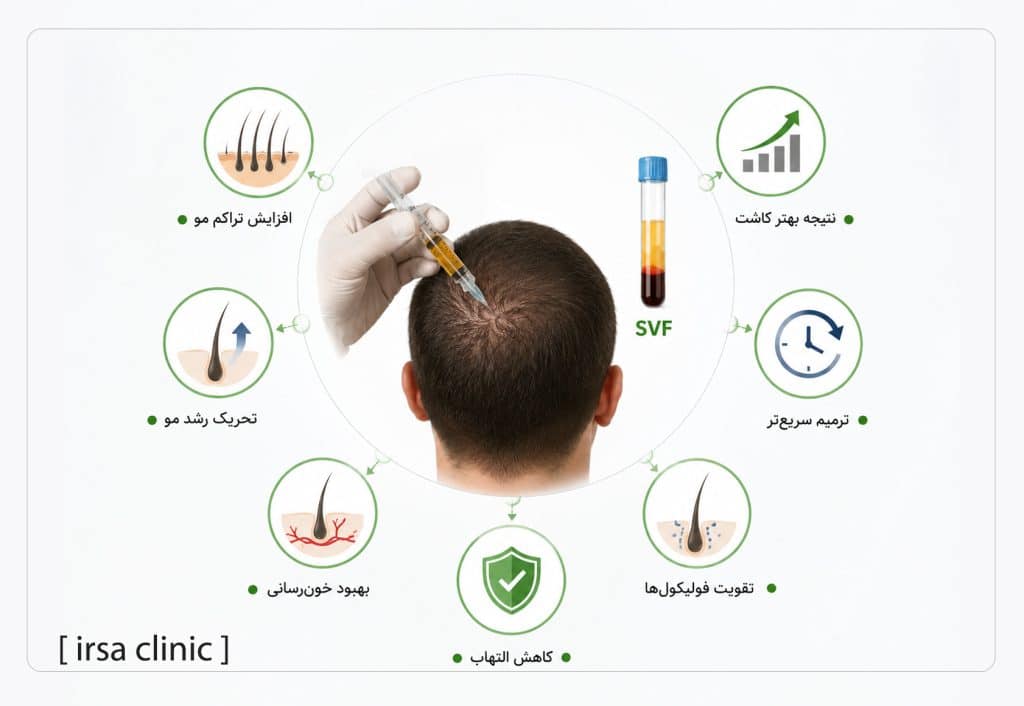 مزایای تزریق SVF بعد از کاشت مو در شیراز چیست؟