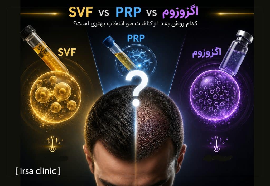 SVF، PRP یا اگزوزوم؟ کدام روش بعد از کاشت مو در شیراز انتخاب بهتری است؟