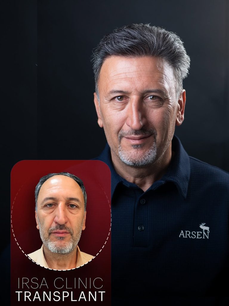 نمونه کار قبل وبعد کاشت مو در کلینیک ایرسا در شیراز از همه زوایا