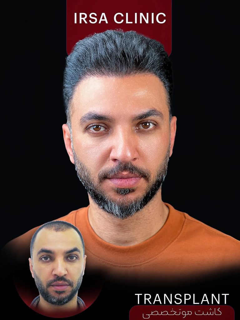 نمونه کار قبل وبعد کاشت مو در کلینیک ایرسا در شیراز از همه زوایا