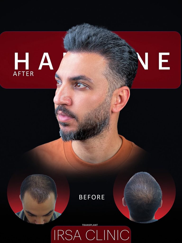 نمونه کار قبل وبعد کاشت مو در کلینیک ایرسا در شیراز از همه زوایا